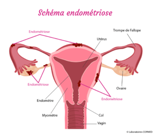 Soulager l'endométriose naturellement